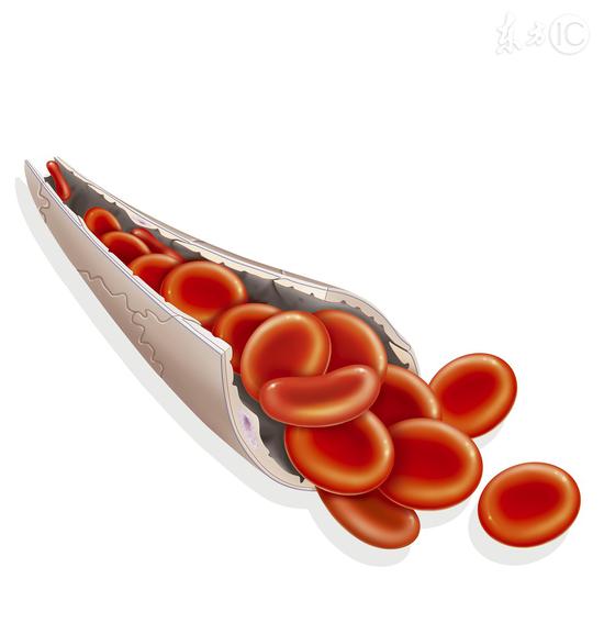 血管堵塞有三個明顯的信號