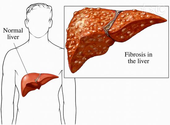 這些人得肝病概率高|肝臟|肝癌