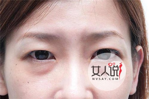 眼袋是什么原因引起的 眼部的肌膚是非常薄的