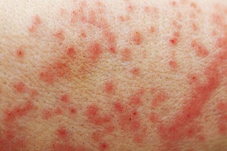 濕疹怎么才能根除？這五個治療護理方法不再復(fù)發(fā)