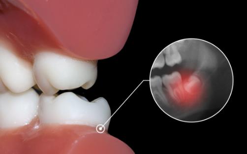 拔智齒減少疼痛需要做好的工作 拔除智齒需知的常識