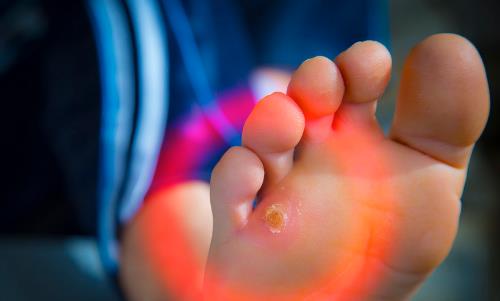 腳下出現(xiàn)老繭比較嚴重 老繭反復去除不掉的原因