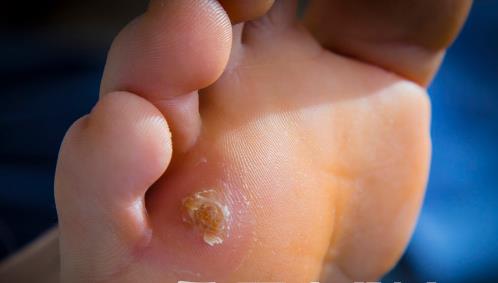 腳下出現(xiàn)老繭比較嚴重 老繭反復去除不掉的原因