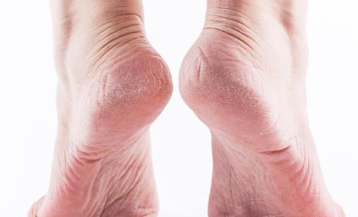 可惡的腳氣就是偏愛(ài)夏天 治療腳氣腳癬食療方