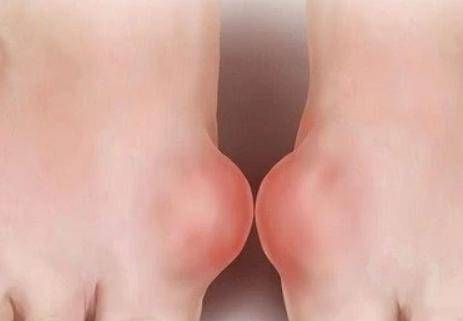 “一日痛風(fēng)，終身痛風(fēng)”什么是痛風(fēng)病？