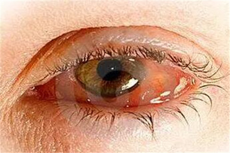 紅眼病傳染嗎，真的看一眼就感染嗎