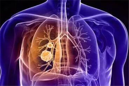 肺結(jié)核會傳染嗎，盤點主要的傳播途徑