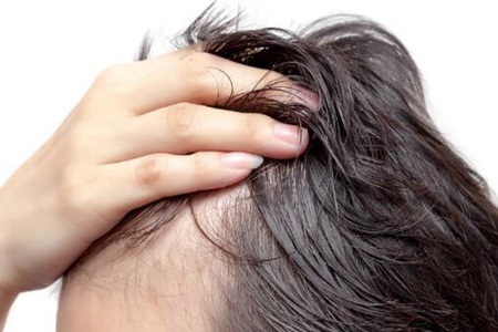掉頭發(fā)男性是什么原因？這五個(gè)關(guān)鍵因素必須重視改善