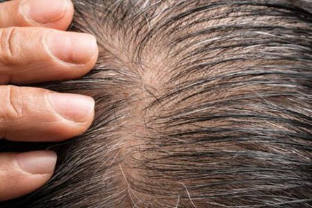 掉頭發(fā)男性是什么原因？這五個(gè)關(guān)鍵因素必須重視改善