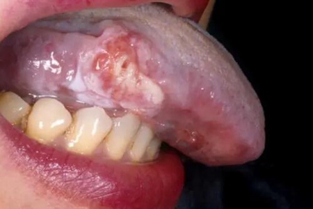 舌頭上潰瘍怎么治？這四個方法能快速愈合潰瘍