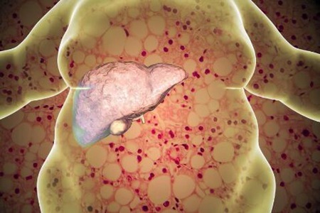 脂肪肝是什么原因造成的？這五個原因造成要及時改正