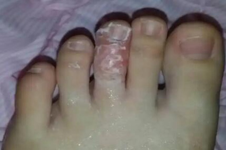 腳氣爛腳趾縫癢潰爛怎么治？這三個方法能腳氣反復折磨癢