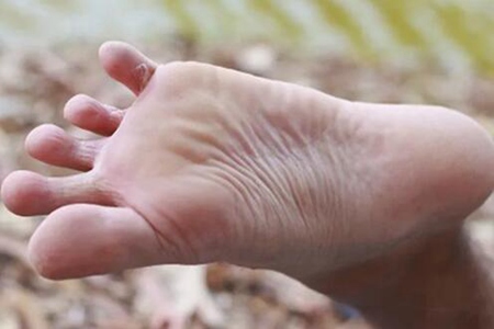 腳氣爛腳趾縫癢潰爛怎么治？這三個方法能腳氣反復折磨癢