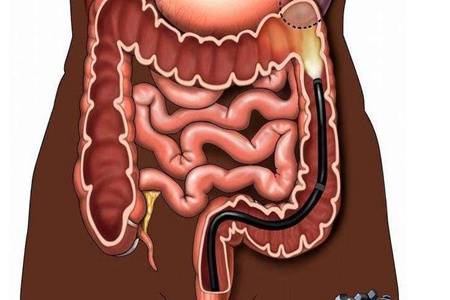 為什么不建議年輕人做腸鏡 無痛檢查多少錢一次適合什么人