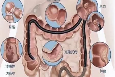 為什么不建議年輕人做腸鏡 無痛檢查多少錢一次適合什么人