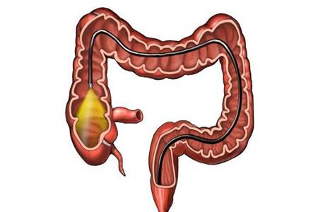 為什么不建議年輕人做腸鏡 無痛檢查多少錢一次適合什么人