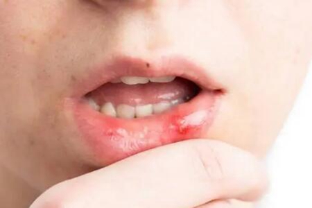 這四個方法能緩解口腔潰瘍痛苦 口腔潰瘍怎么辦？
