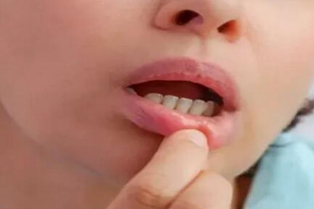 這四個方法能緩解口腔潰瘍痛苦 口腔潰瘍怎么辦？