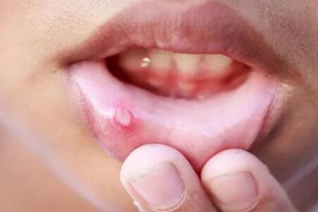 這四個方法能緩解口腔潰瘍痛苦 口腔潰瘍怎么辦？