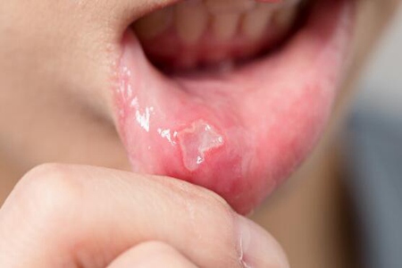經(jīng)常口腔潰瘍?cè)趺崔k？這五個(gè)方法讓它快點(diǎn)消失
