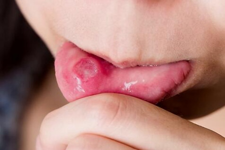 經(jīng)常口腔潰瘍?cè)趺崔k？這五個(gè)方法讓它快點(diǎn)消失