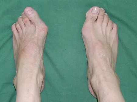 大腳骨突出疼痛矯正最佳3種治療方法