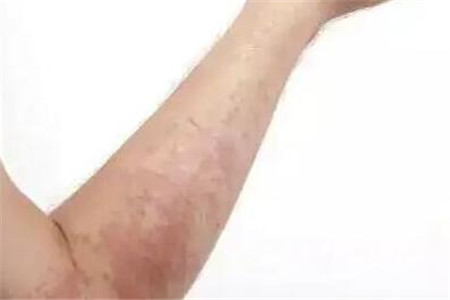 濕疹傳染嗎？注意常見的病因