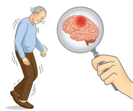 腦梗的癥狀都有哪些 如何自測(cè)及預(yù)防腦梗7大點(diǎn)